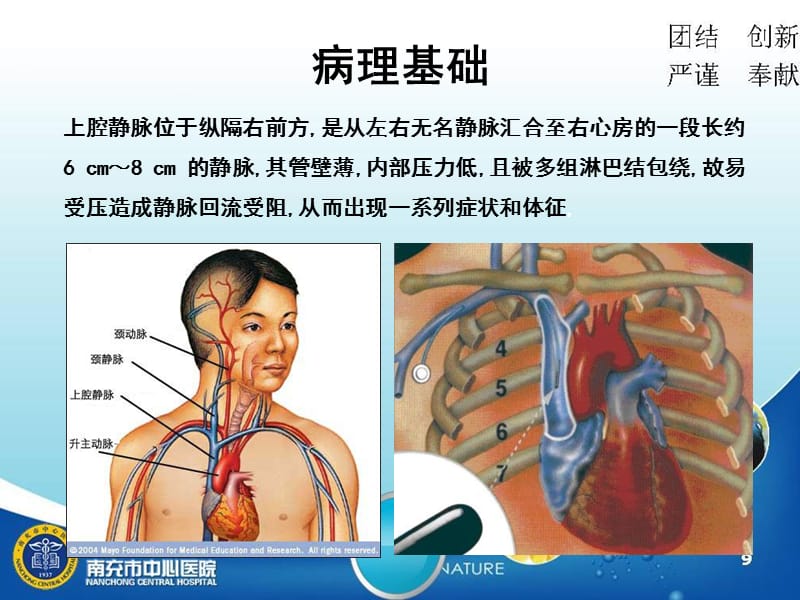 2018年上腔静脉综合征护理查房-文档资料.ppt_第2页