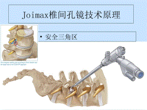 2018年椎间孔镜手术操作方法-文档资料.ppt