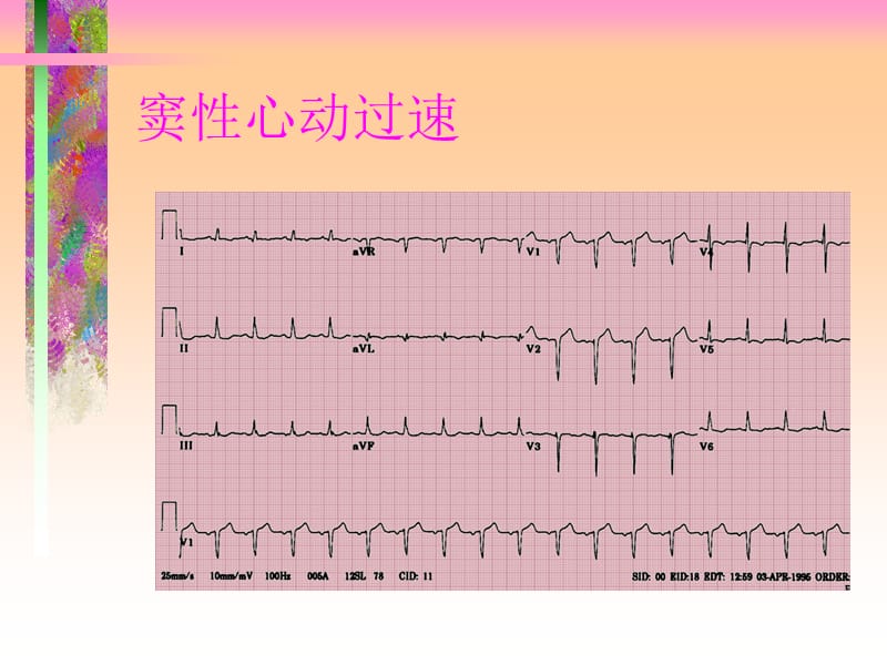 2018年【医药健康】围术期心律失常-文档资料.ppt_第3页