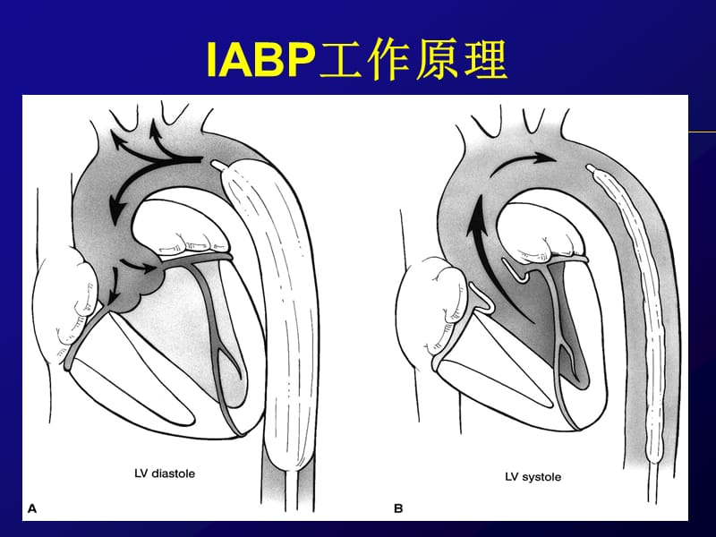 IABP的临床应用——2010-精选文档.pptx_第2页