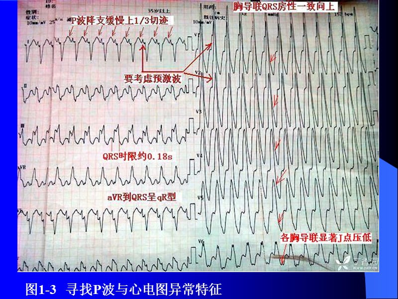 2018年P波的识别与相关病例讨论之四-文档资料.ppt_第3页