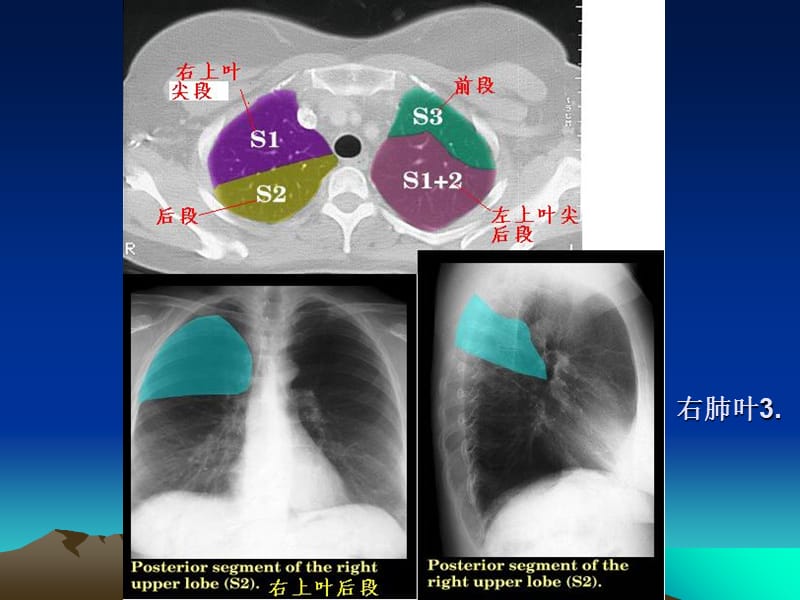 CT正常彩色解剖图肺段-PPT文档.ppt_第3页