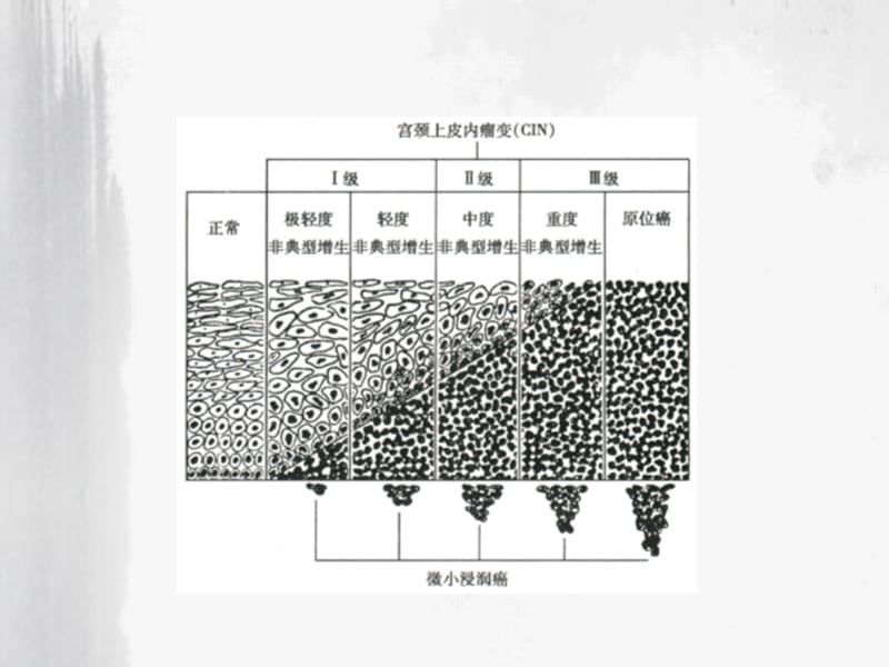 宫颈癌癌前病变症状-文档资料.ppt_第3页