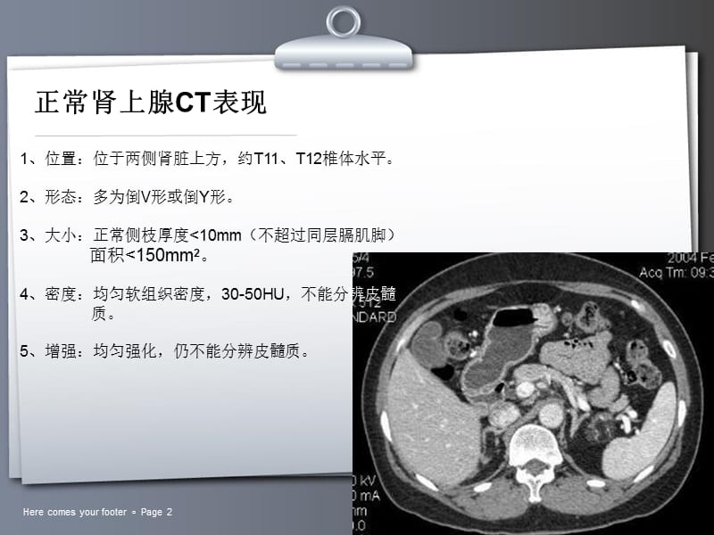 常见肾上腺肿瘤的ct诊断与鉴别诊断-文档资料.ppt_第2页