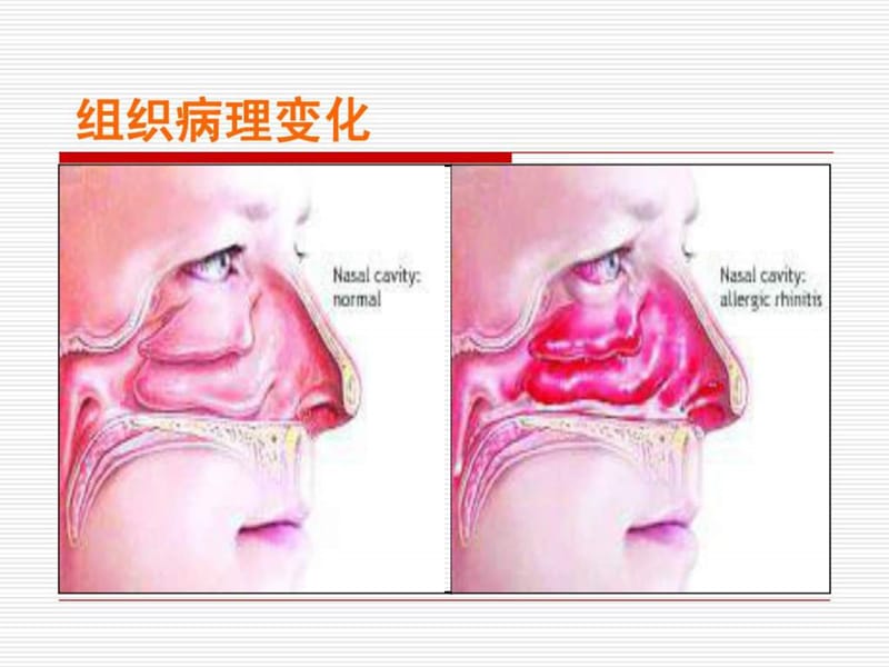 中药保健第四讲--过敏性鼻炎防治-精选文档.ppt_第3页