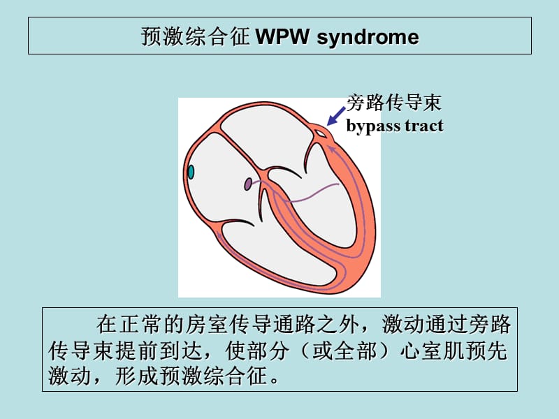 心电图课件预激综合症2lxh-PPT文档.ppt_第1页