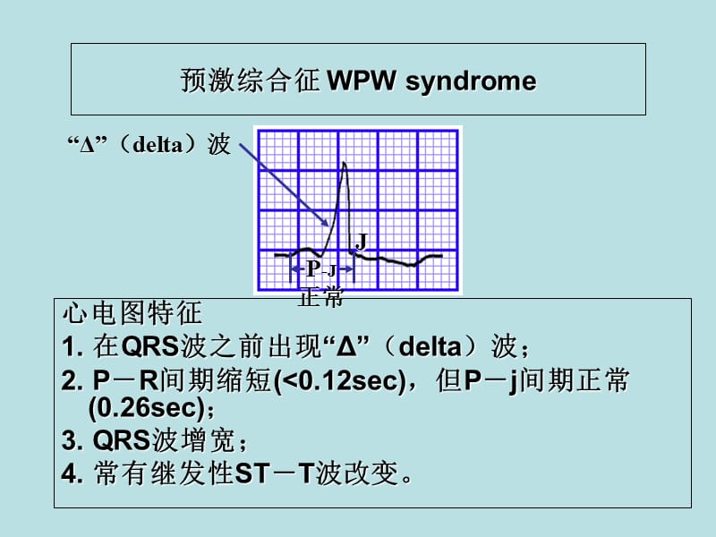 心电图课件预激综合症2lxh-PPT文档.ppt_第2页