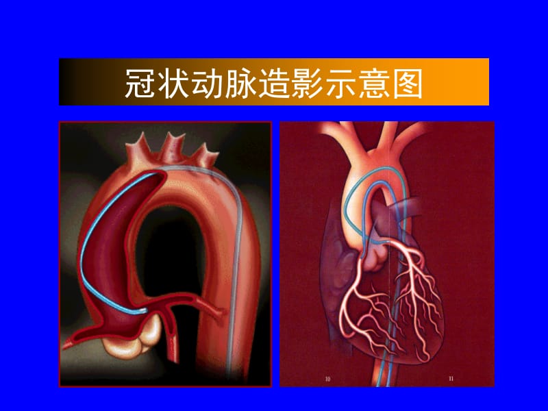 2018年心血管疾病介入治疗-文档资料.ppt_第3页