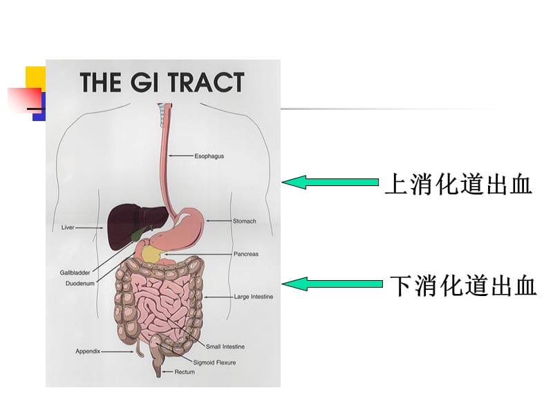 上消化道大出血病人护理-PPT文档.ppt_第2页