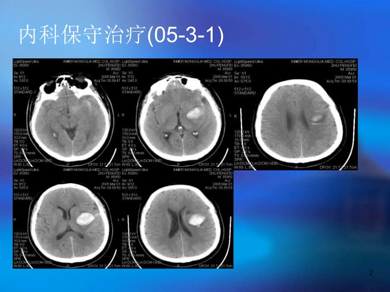 微创颅内血肿粉碎清除术在神经内科的应用-PPT文档.ppt_第2页