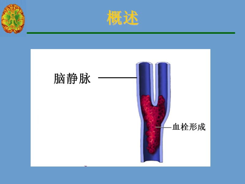 2018年脑静脉系统血栓形成宣武医院演示文稿1-文档资料.ppt_第3页