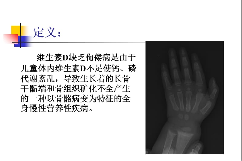 2018年维生素D缺乏性佝偻病-儿科学-新华医院-文档资料.ppt_第1页