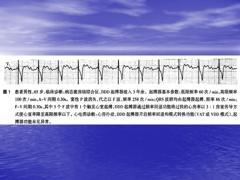 2018年起搏器心电图简释-常州第二人民医院-刘敏-文档资料.ppt_第2页