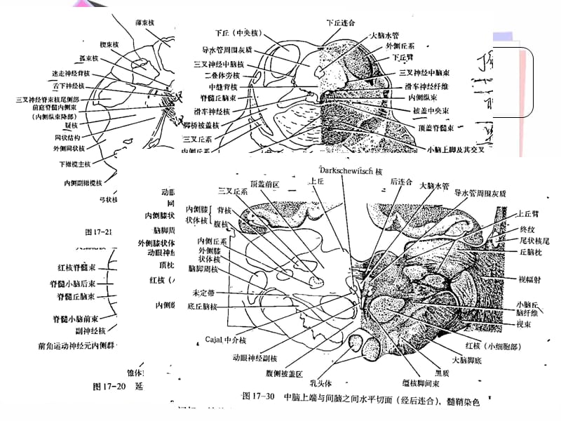 常见的脑干损害综合征-文档资料.ppt_第3页