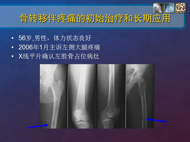 2018年肺癌骨转移病例讨论规范用药ppt课件-文档资料.ppt_第1页