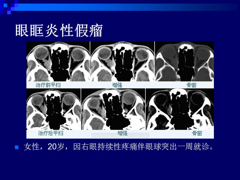 五官和颈部典型病例影像读片-文档资料.ppt_第1页