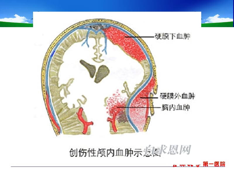 影像学-脑外伤-一院-文档资料.ppt_第3页