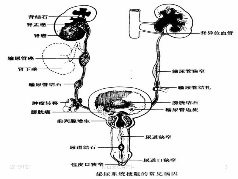 尿路感染病人的护理描述最全面-PPT文档.ppt_第3页