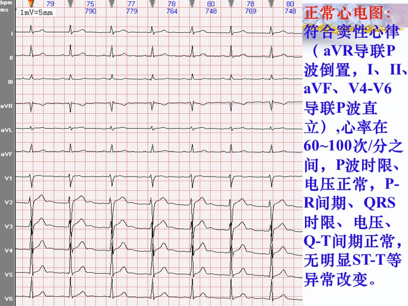 2018年常见心电图诊断-实习生教案之二-文档资料.ppt_第3页