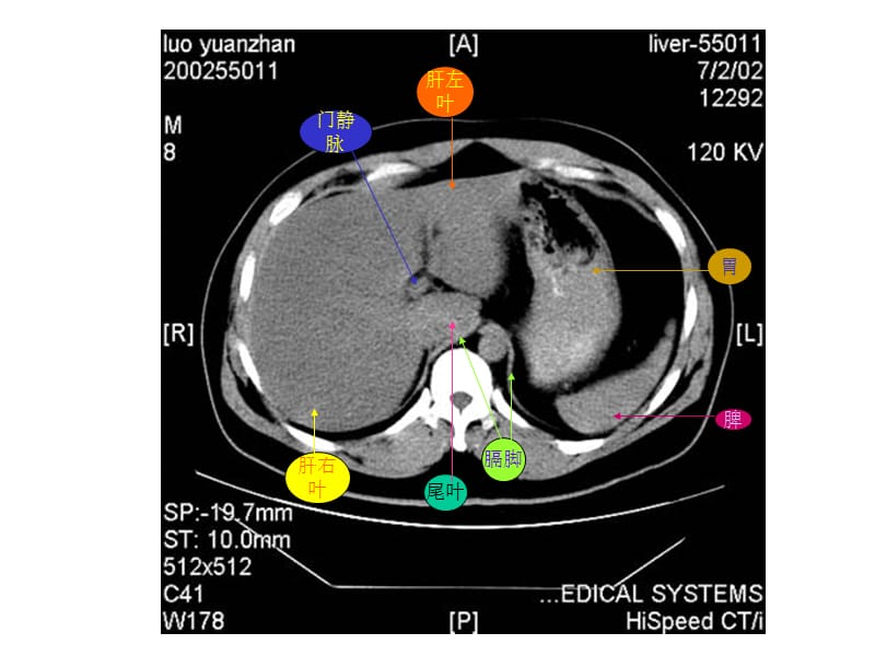【共享】超好的腹部CT学习图片及PPT资料-PPT文档.ppt_第3页