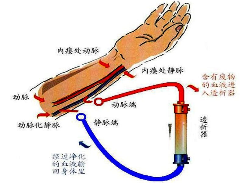 动静脉内瘘的围手术期护理ppt课件-PPT文档.ppt_第3页