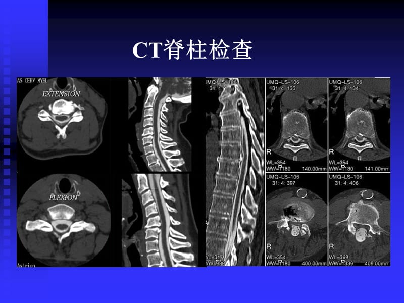 《脊柱肿瘤》-精选文档.ppt_第1页