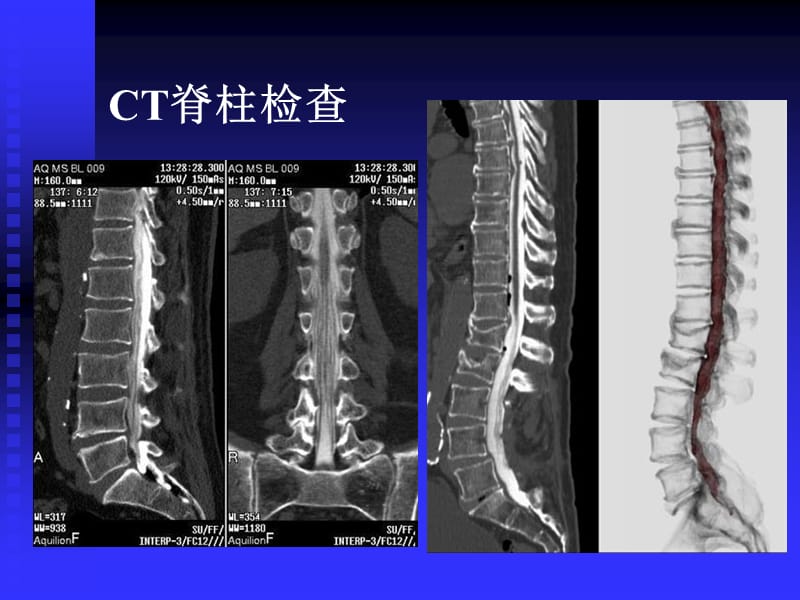 《脊柱肿瘤》-精选文档.ppt_第2页