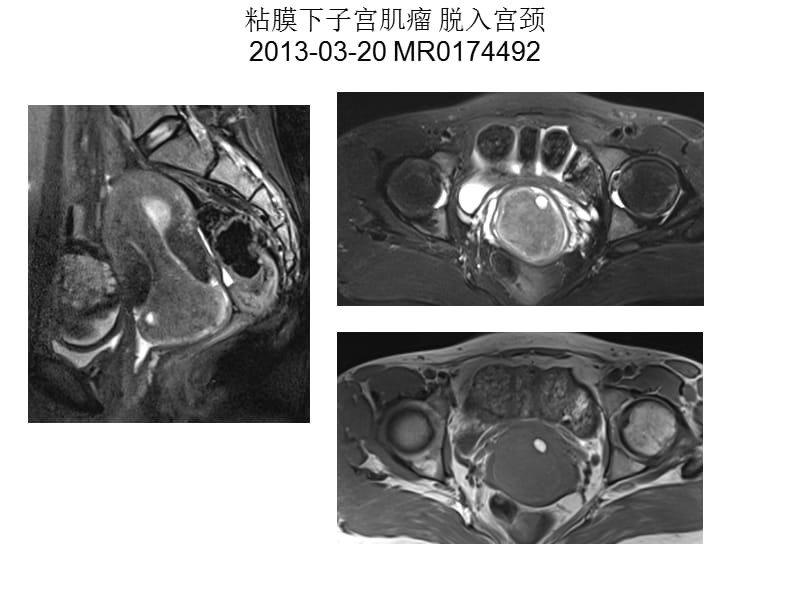 女性盆腔疾病mr读片ppt课件-精选文档.ppt_第2页