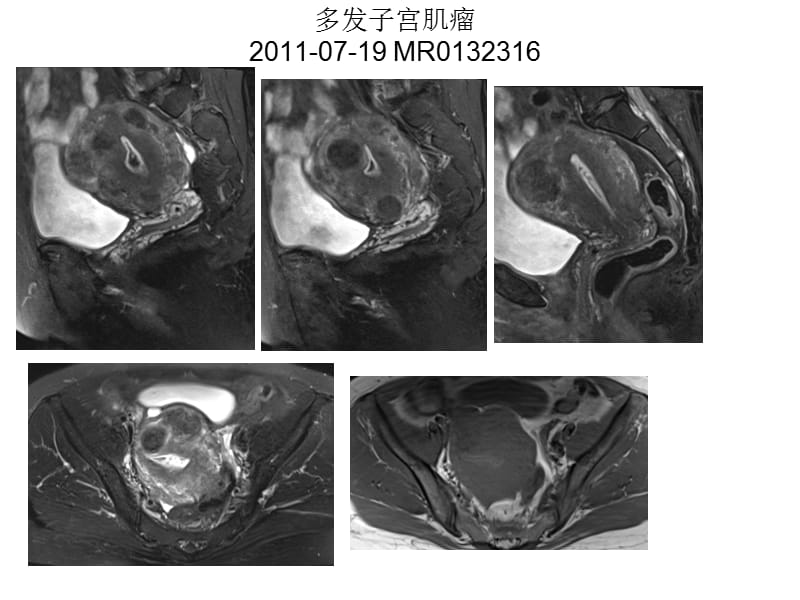 女性盆腔疾病mr读片ppt课件-精选文档.ppt_第3页