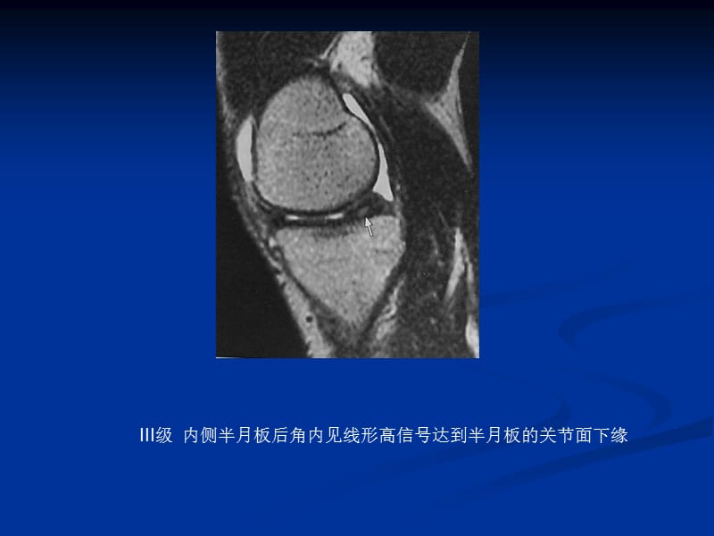 最新0053膝关节半月板病变MRI病例图片及分析-PPT文档-文档资料.ppt_第3页