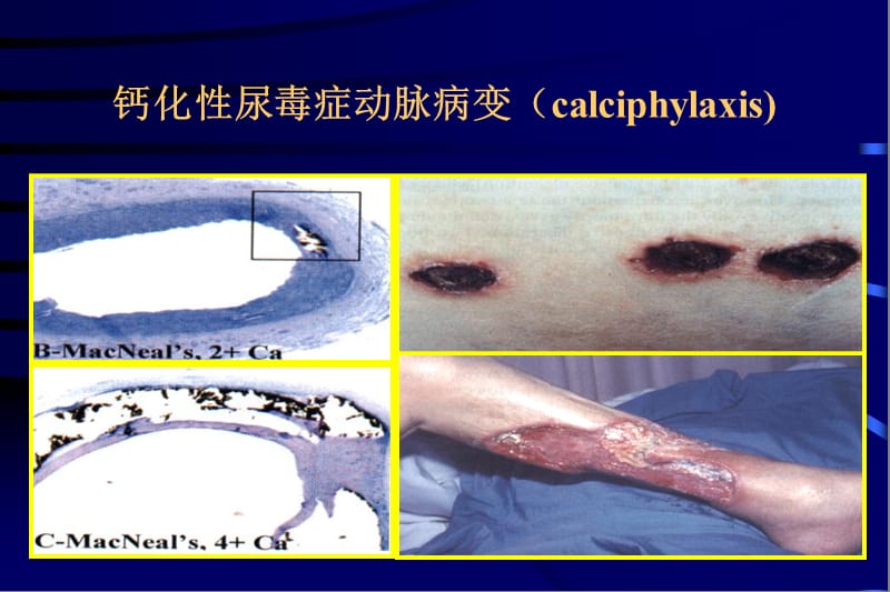 2018年慢性肾脏病时的钙磷代谢异常及骨病-文档资料.ppt_第3页