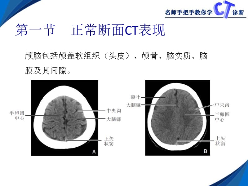 2018年第二章颅脑CT-文档资料.ppt_第1页