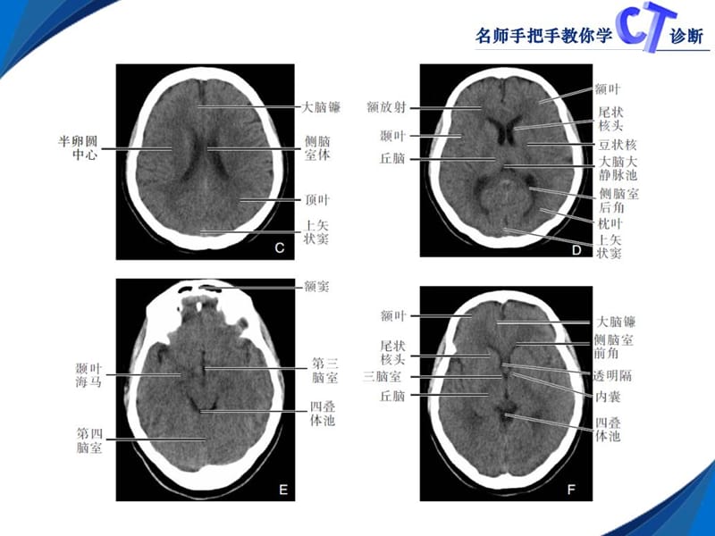 2018年第二章颅脑CT-文档资料.ppt_第2页