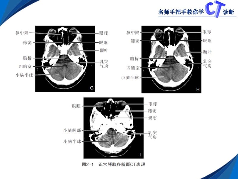 2018年第二章颅脑CT-文档资料.ppt_第3页