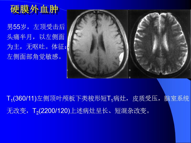 2018年10-MRI图像-脑1-文档资料.ppt_第2页