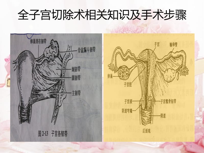 2018年经腹全子宫切除术相关知识及手术步骤-文档资料.pptx_第3页