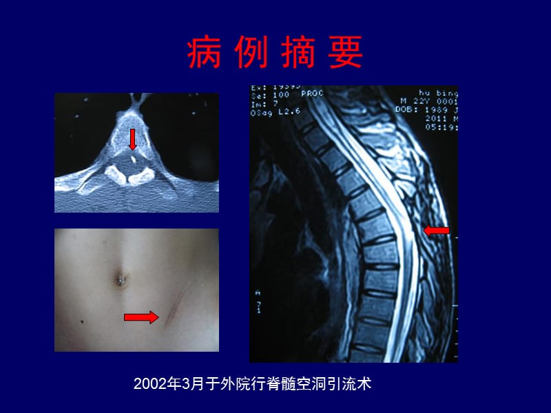 最新chiari畸形的诊断及治疗病例报道并文献复习-文档资料.ppt_第3页