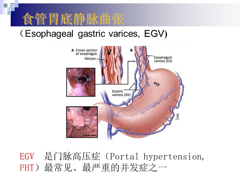 2015食管胃底静脉曲张出血的内镜诊治指南解读-精选文档.ppt_第2页