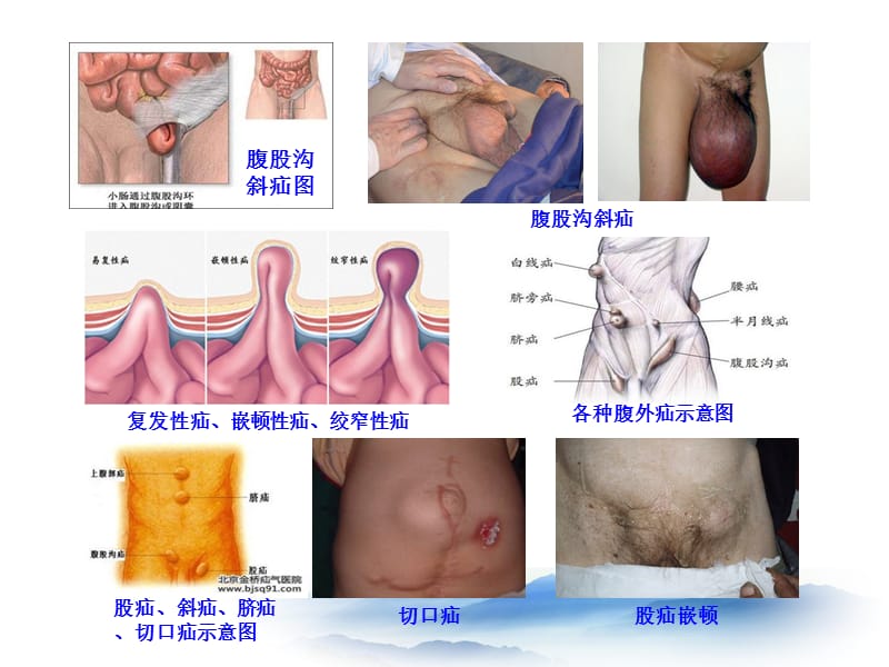 普外科常见病知识-文档资料.ppt_第3页