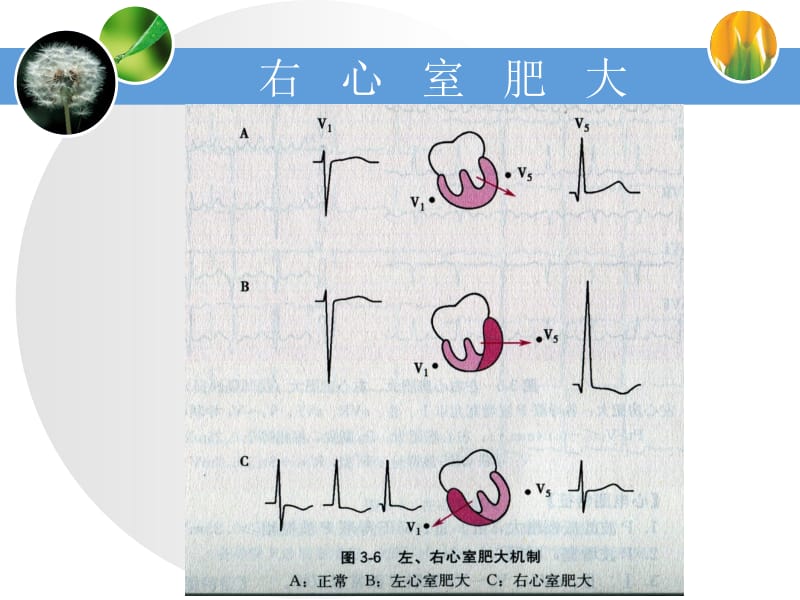 右心室肥大-文档资料.ppt_第1页