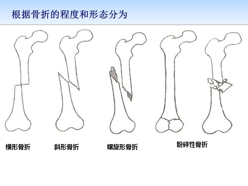 2018年一例颅脑损伤合并多发骨折术前术后个案护理-文档资料.pptx_第3页