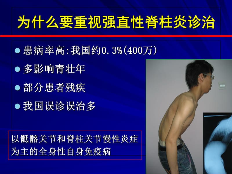 强直性脊柱炎的诊断和治疗-精选文档.ppt_第3页