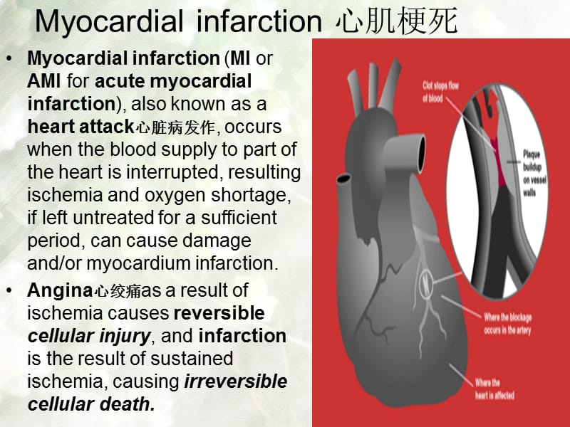 内科护理学课件 英语 考试资料myocardial+infarction-文档资料.ppt_第1页