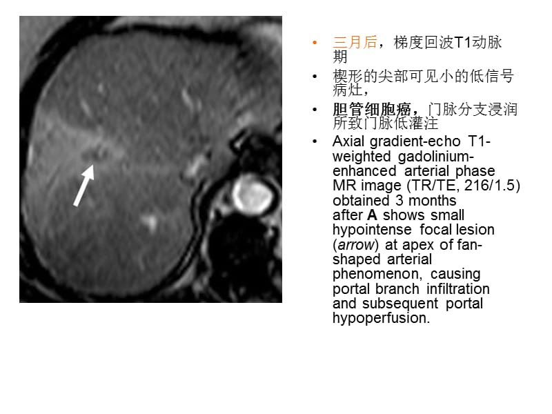 2018年肝脏动脉期一过性强化灶-文档资料.ppt_第3页