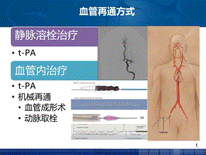 刘丽萍-急性卒中血管再通治疗后管理-0408-精选文档.pptx