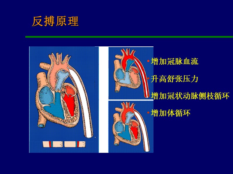 主动脉内球囊反搏泵-PPT文档.ppt_第2页