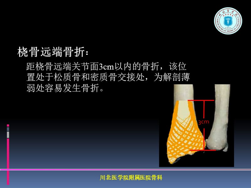 掌背侧钢板治疗桡骨远端骨折ppt课件-文档资料.ppt_第1页