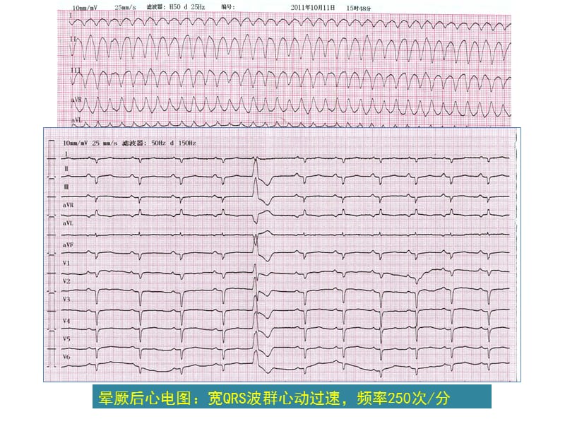 抗心律失常之选-胺碘酮的临床应用-精选文档.ppt_第2页