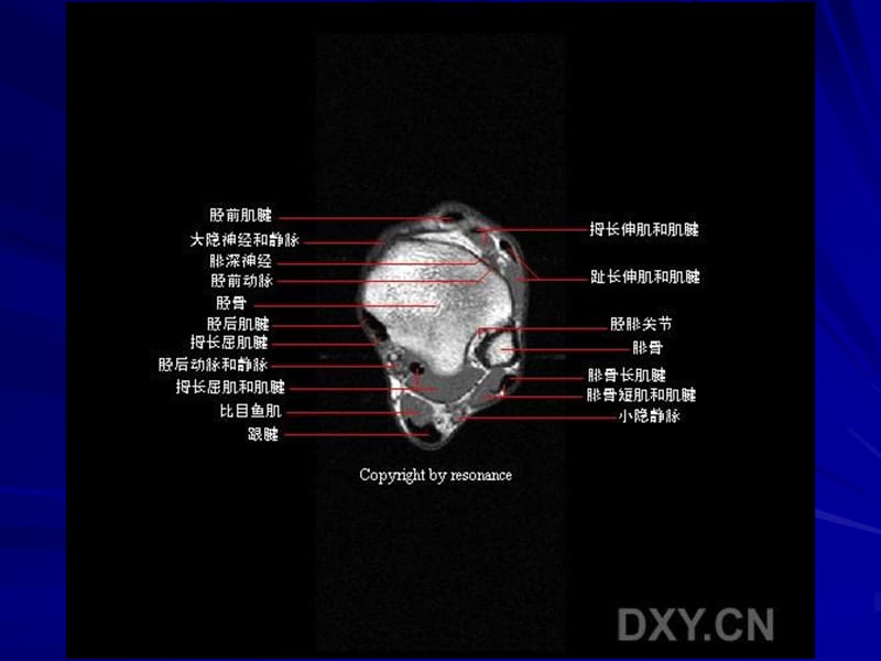 最新正常踝关节mr解剖-PPT文档.ppt_第2页