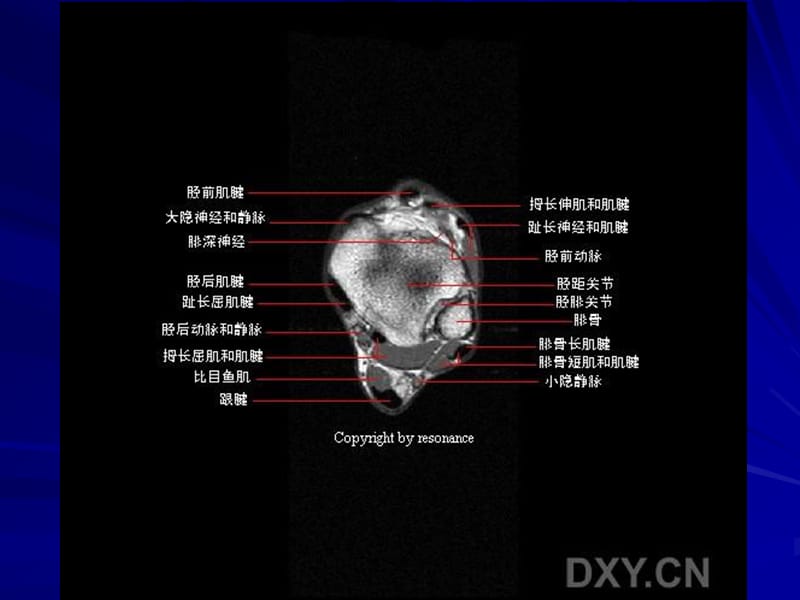 最新正常踝关节mr解剖-PPT文档.ppt_第3页